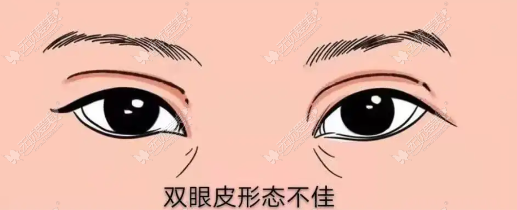 深圳富华做双眼皮修复哪几位医生比较好
