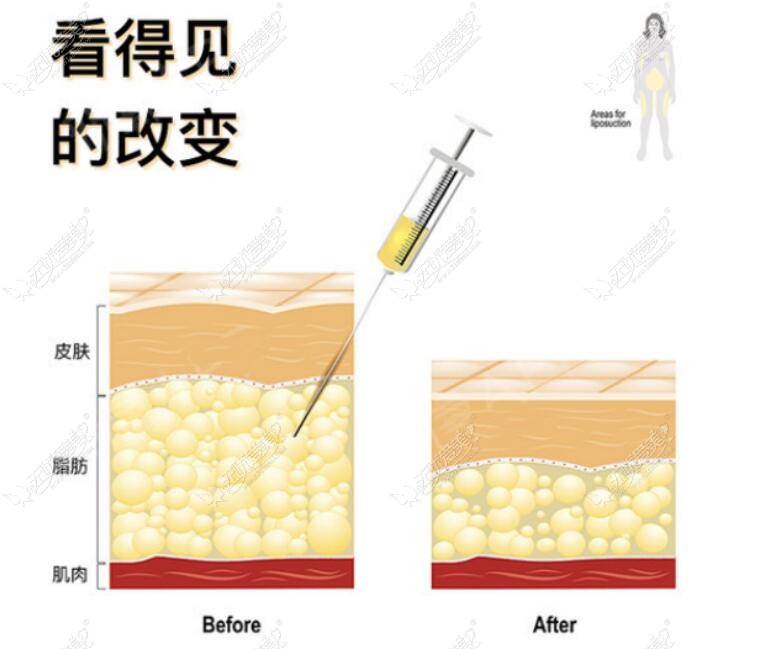 长沙吸脂医生排名榜前十名公布,吸脂好的欧阳鑫,周文亮大腿吸脂有名