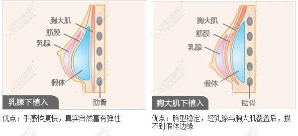 南宁假体隆胸哪个医生好 南宁假体隆胸哪个医生好