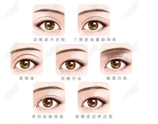 常州双眼皮修复医生排名榜 常州双眼皮修复医生排名榜
