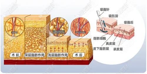 西安吸脂减肥手术医院名单 西安吸脂减肥手术医院名单