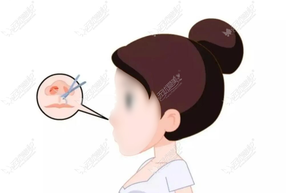 沈阳哪个医院做鼻综合好