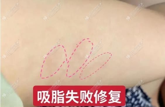 北京做脂肪修复牛的医生都有谁 北京做脂肪修复牛的医生都有谁