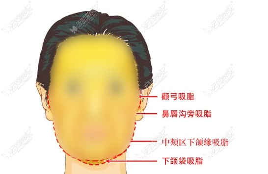 广州面部吸脂好的医生 广州面部吸脂好的医生