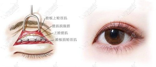 荆州中爱整形做双眼皮技术图