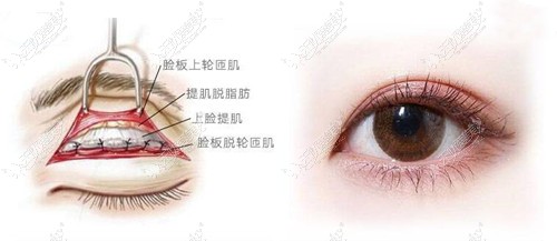 荆州中爱整形做双眼皮技术图 荆州中爱整形做双眼皮技术图