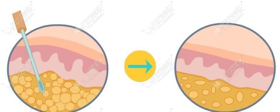 西安美莱吸脂医生资质高