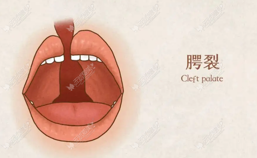 杭州唇裂整形好的医院排名前三 杭州唇裂整形好的医院排名前三