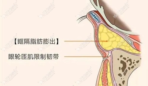 太原眼袋手术好的医生推荐