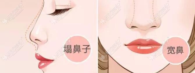 厦门海峡做鼻子好的医生是谁