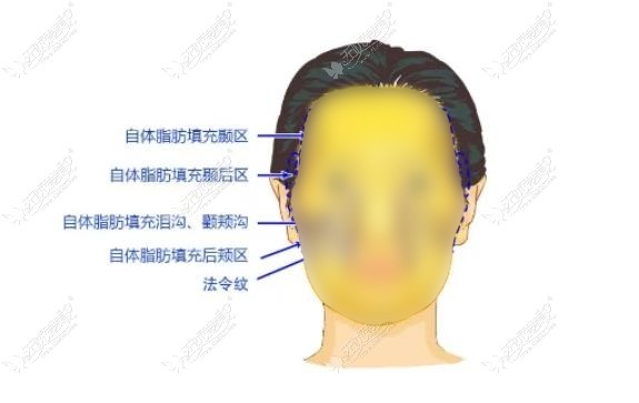 杭州脂肪填充的名医 杭州脂肪填充的名医