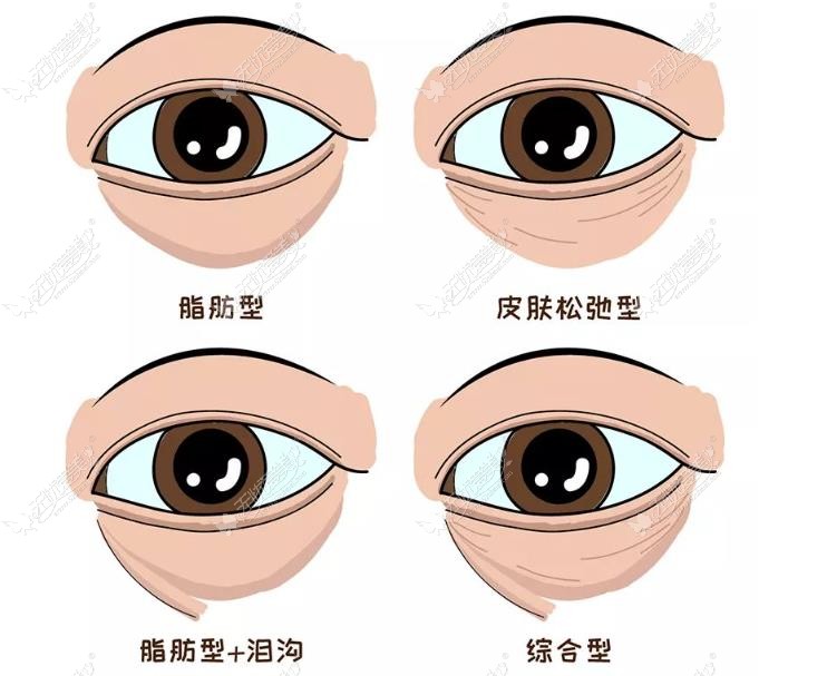 杭州割眼袋靠谱的医生 杭州割眼袋靠谱的医生