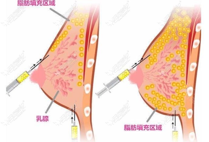 重庆军科自体脂肪隆胸医生推荐 重庆军科自体脂肪隆胸医生推荐