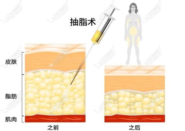 南京吸脂做得好的医生抽脂技术优势