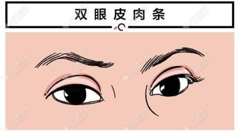 南京割双眼皮修复疤痕医生推荐