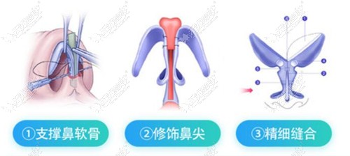临沂假体隆鼻医生推荐