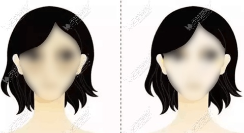 佛山去眼袋手术好的医生推荐