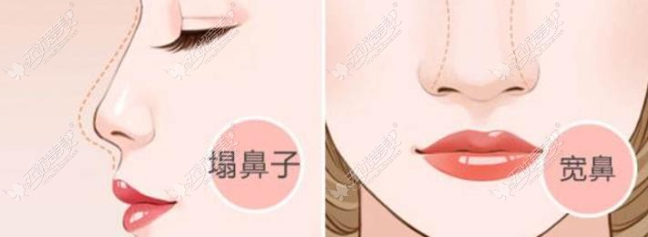 石家庄做鼻子好的医生