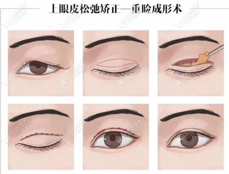 孝感做双眼皮有名的医生技术图