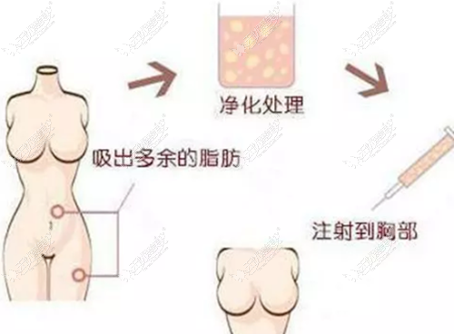 武汉脂肪丰胸医生技术图