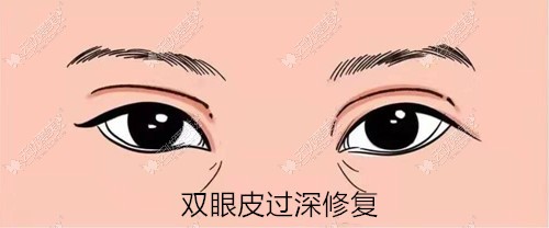 深圳眼修复比较好的医生揭晓,能修复双眼皮过深的医生有5名
