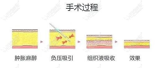 温州吸脂医生排名推荐