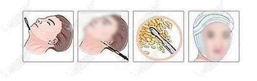 温州吸脂哪个医生好些51aimei.com