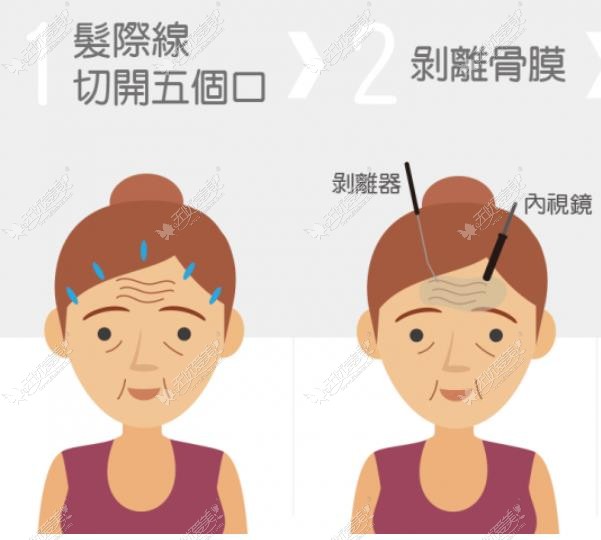 福州拉皮手术医生排名 福州拉皮手术医生排名