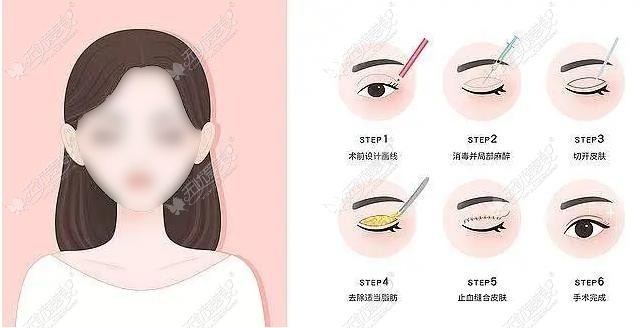 佛山割双眼皮哪个医生好 佛山割双眼皮哪个医生好