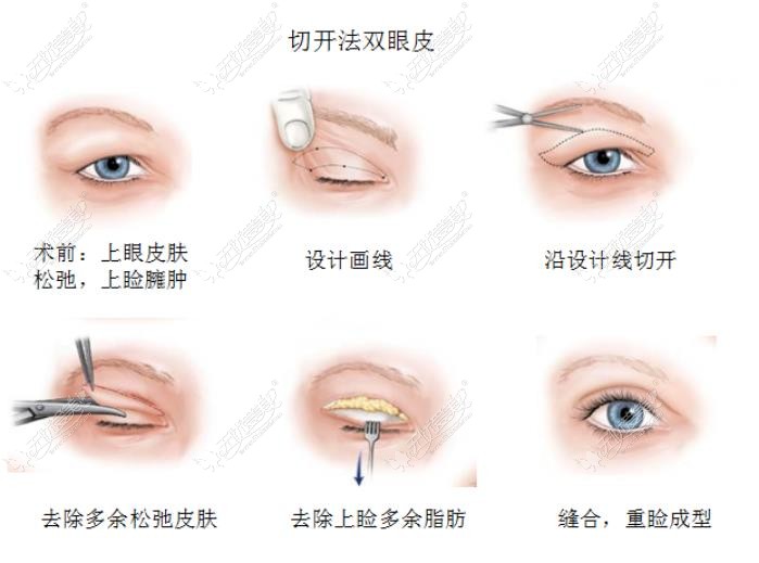 昆明做双眼皮好的医生 昆明做双眼皮好的医生