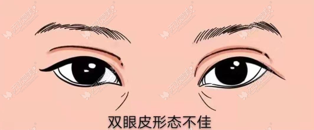 昆明做双眼皮手术有名的医生 昆明做双眼皮手术有名的医生