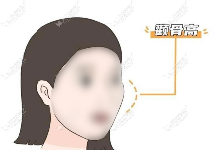 成都做颧骨手术好的医生