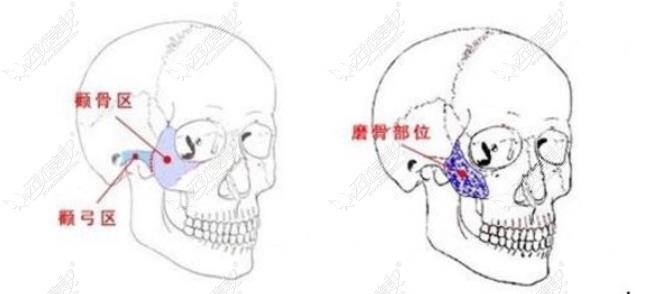 成都做颧骨内推比较有名的医生