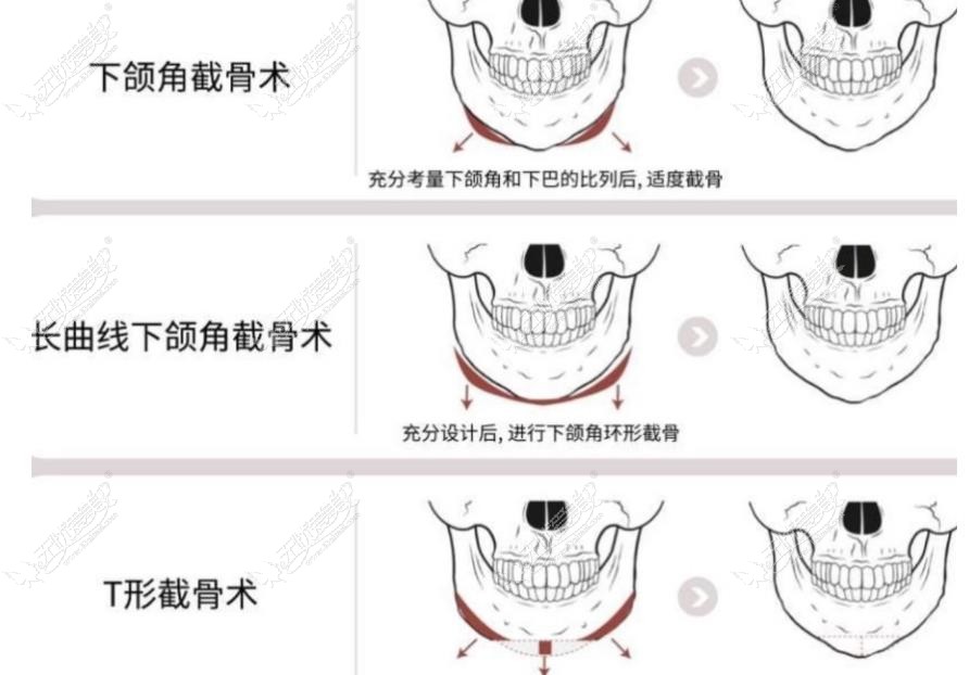 广州磨骨医生排名前三 广州磨骨医生排名前三
