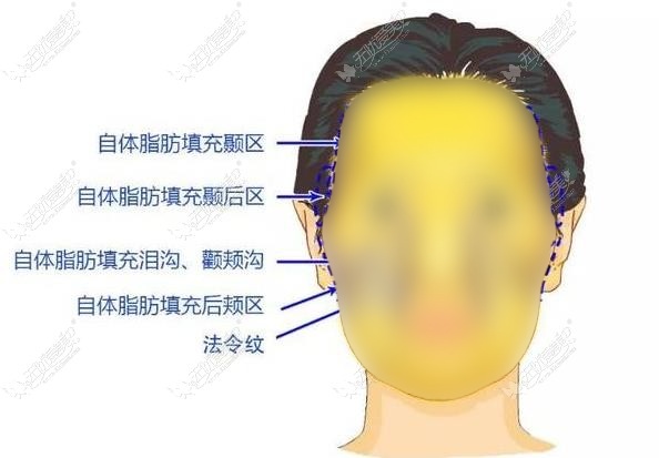 西安面部脂肪填充哪个医生好?赵敬国|陈伟做自体脂肪丰脸技术高超