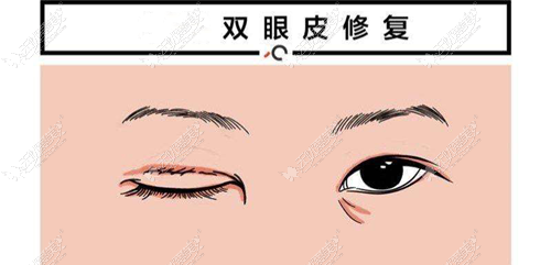 宁波双眼皮修复好的医生排名榜