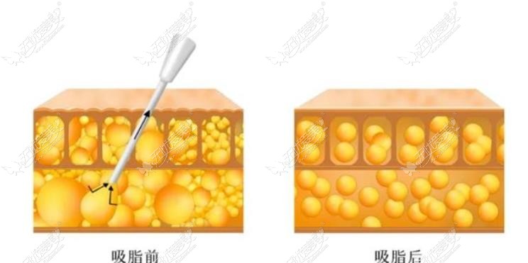 苏州有名吸脂医院www.51aimei.com 苏州有名吸脂医院www.51aimei.com