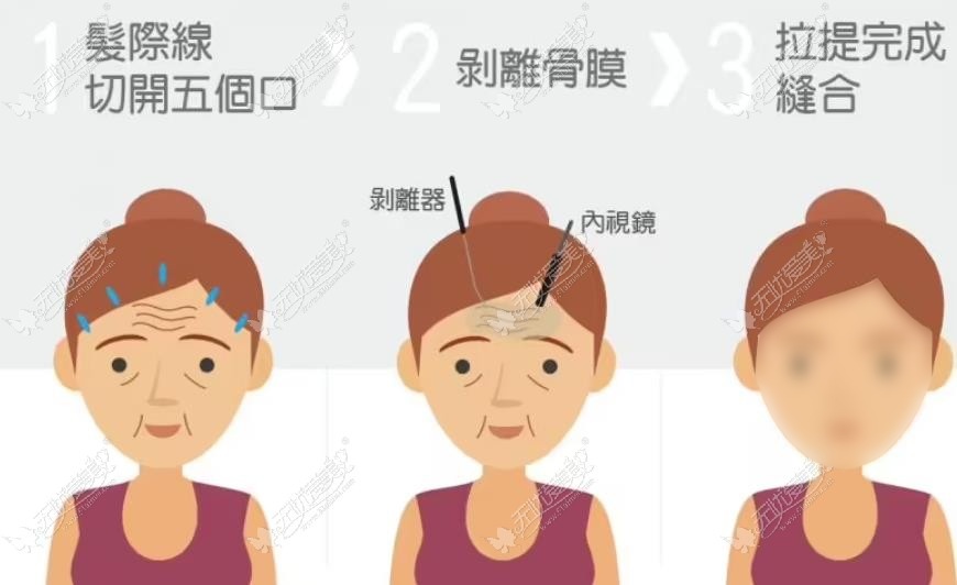 重庆小拉皮手术哪个医院比较擅长