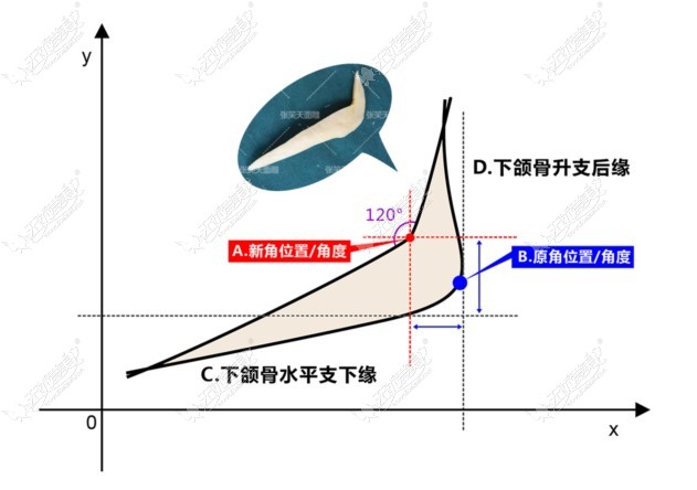 北京圣嘉新下颌角手术优势