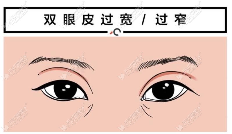 惠州双眼皮修复医生排名www.51aimei.com 惠州双眼皮修复医生排名www.51aimei.com