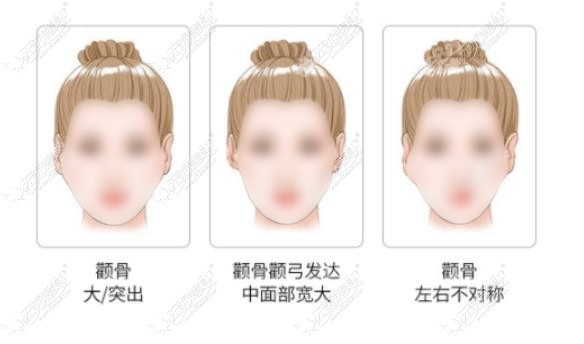 西安谁做削骨好www.51aimei.com