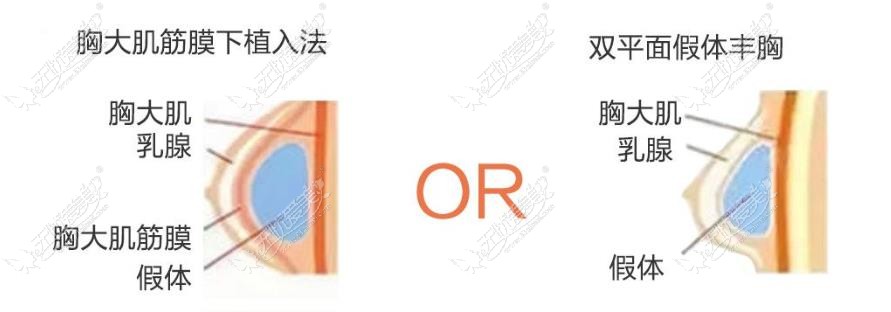 武汉假体丰胸医院排名  无忧爱美网提供