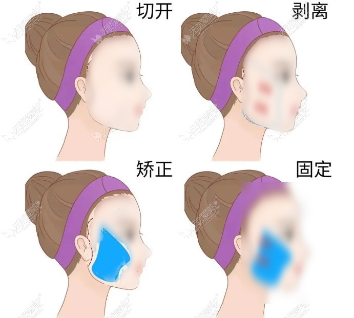 苏州拉皮手术做的好的医生www.51aimei.com 苏州拉皮手术做的好的医生www.51aimei.com