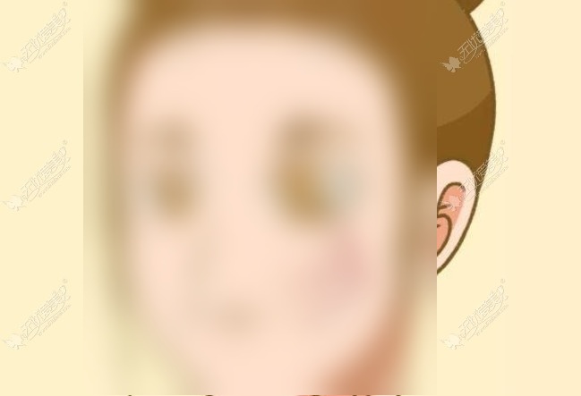 苏州拉皮手术能维持多久 苏州拉皮手术能维持多久