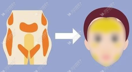 长沙脂肪填充医院排名 长沙脂肪填充医院排名
