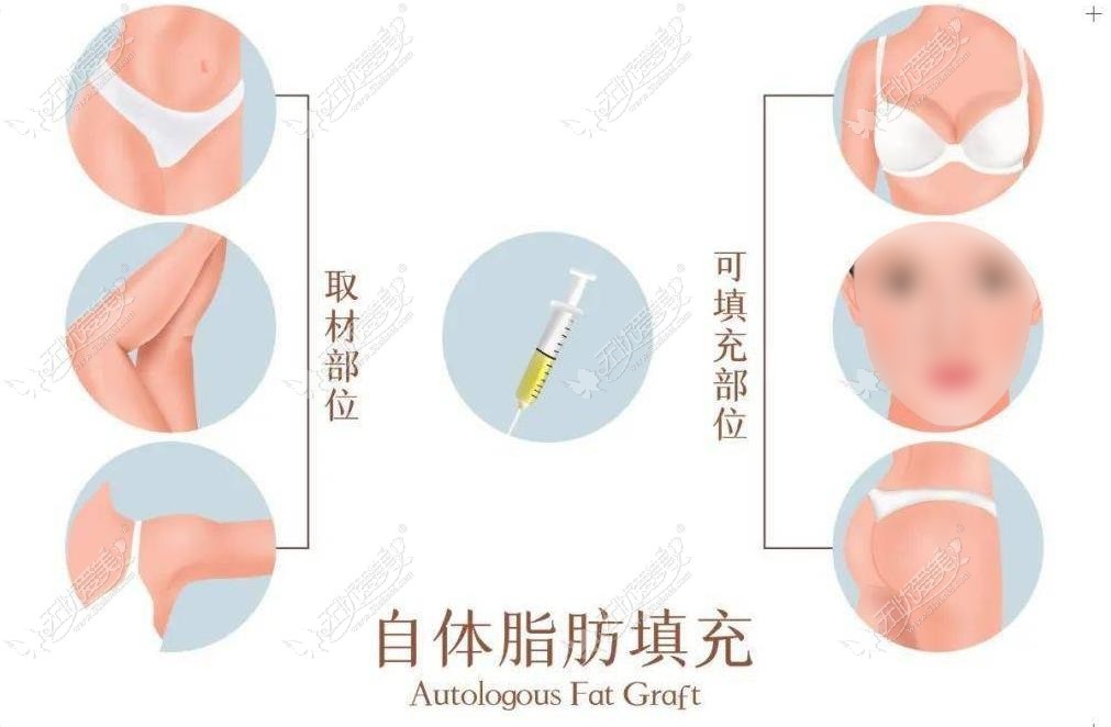 长沙专攻脂肪填充的医院 长沙专攻脂肪填充的医院