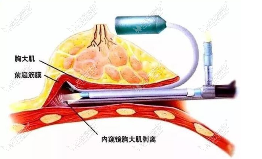 贵阳利美康整形医院是贵阳隆胸用内窥镜的医院 www.51aimei.com