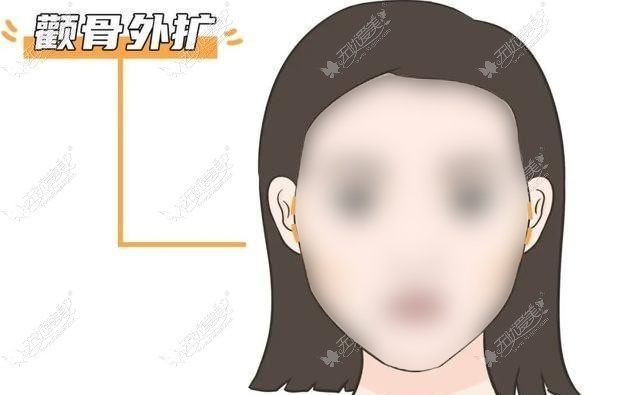 杭州颧骨内推正规医院排名 杭州颧骨内推正规医院排名