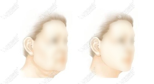 韩国十大拉皮手术好的医院排名 韩国十大拉皮手术好的医院排名