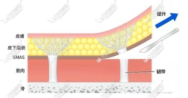 瞿健拉皮手术技术图解